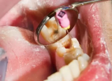 Endodoncia