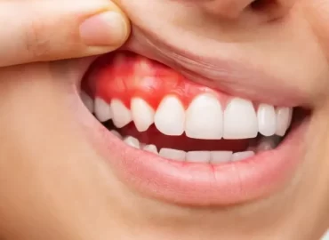 Periodoncia