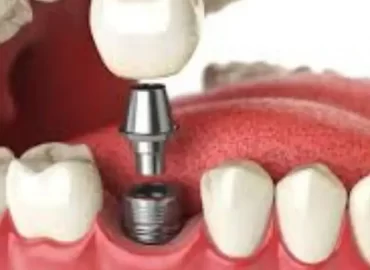 Rehabilitación Oral